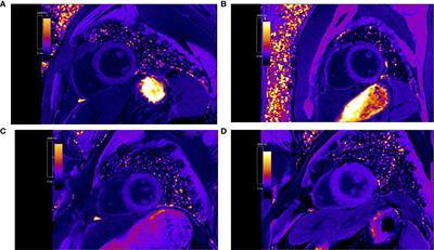 CMR-Verified Myocardial Fibrosis Is Associated With Subclinical Diastolic Dysfunction in Primary Aldosteronism Patients